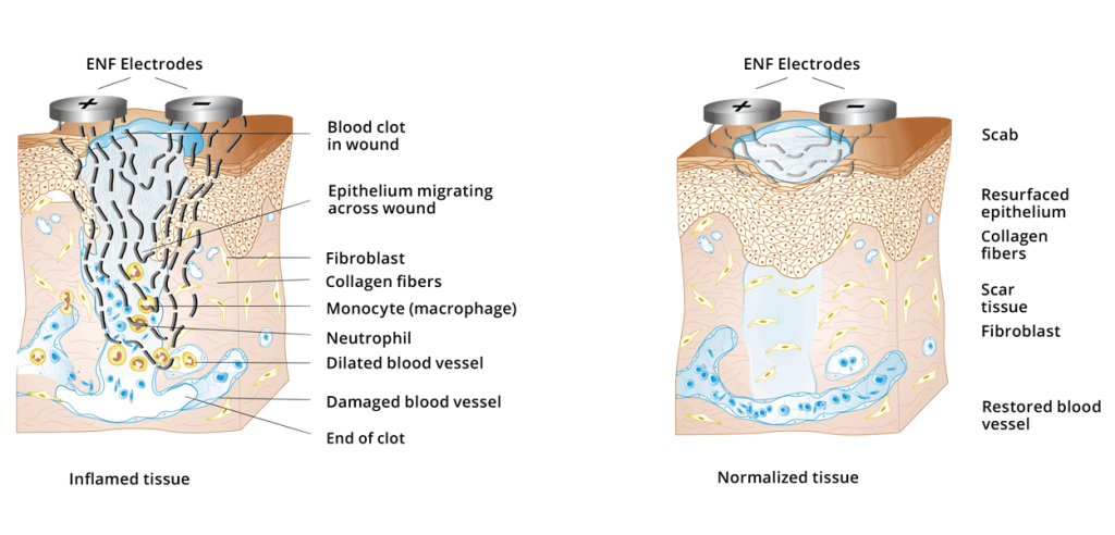 Inflamed and normalized Tissues